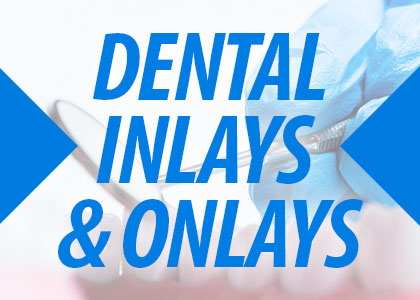 Dental inlays and onlays