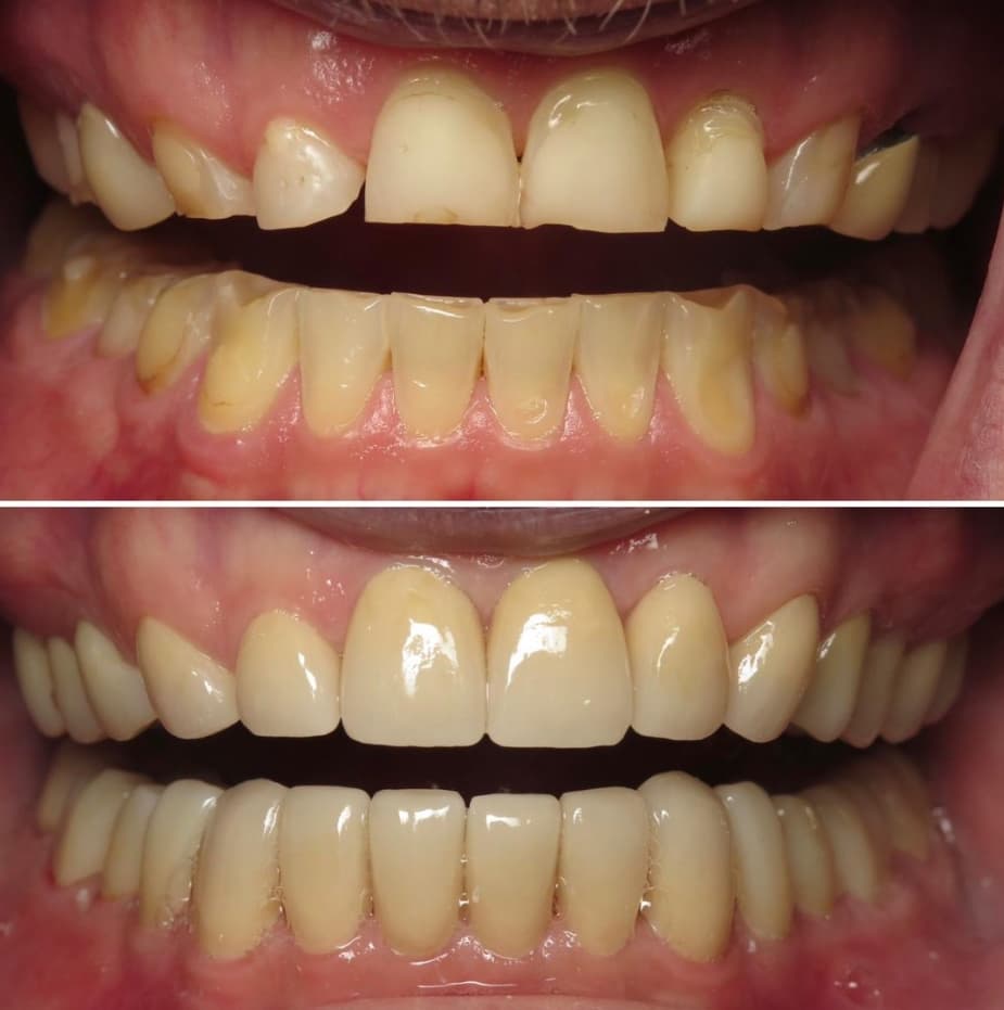 Cosmetic Dentistry Before and After