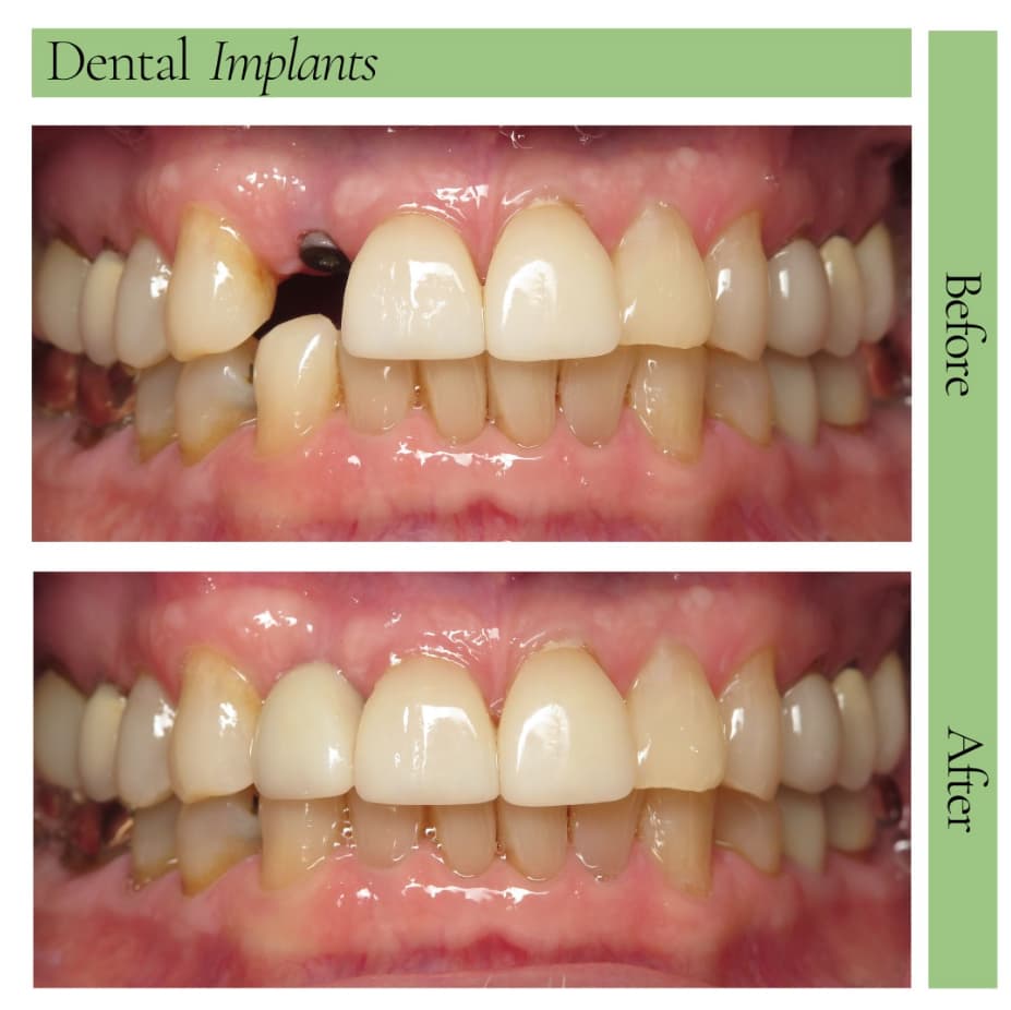 Dental Implants Before and After