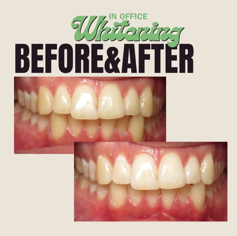 Teeth whitening before and after